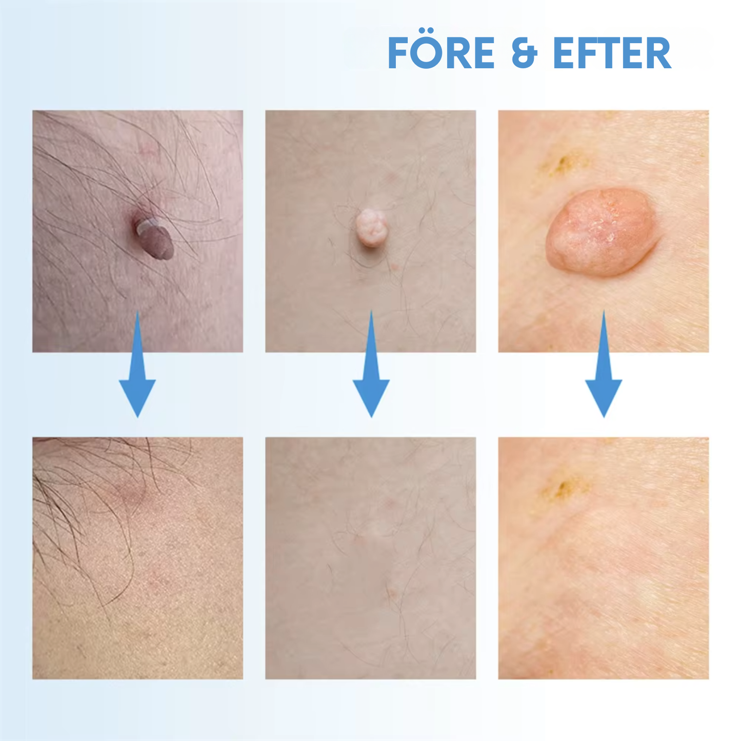 CuraMeda Flikfri™ Komplett Set