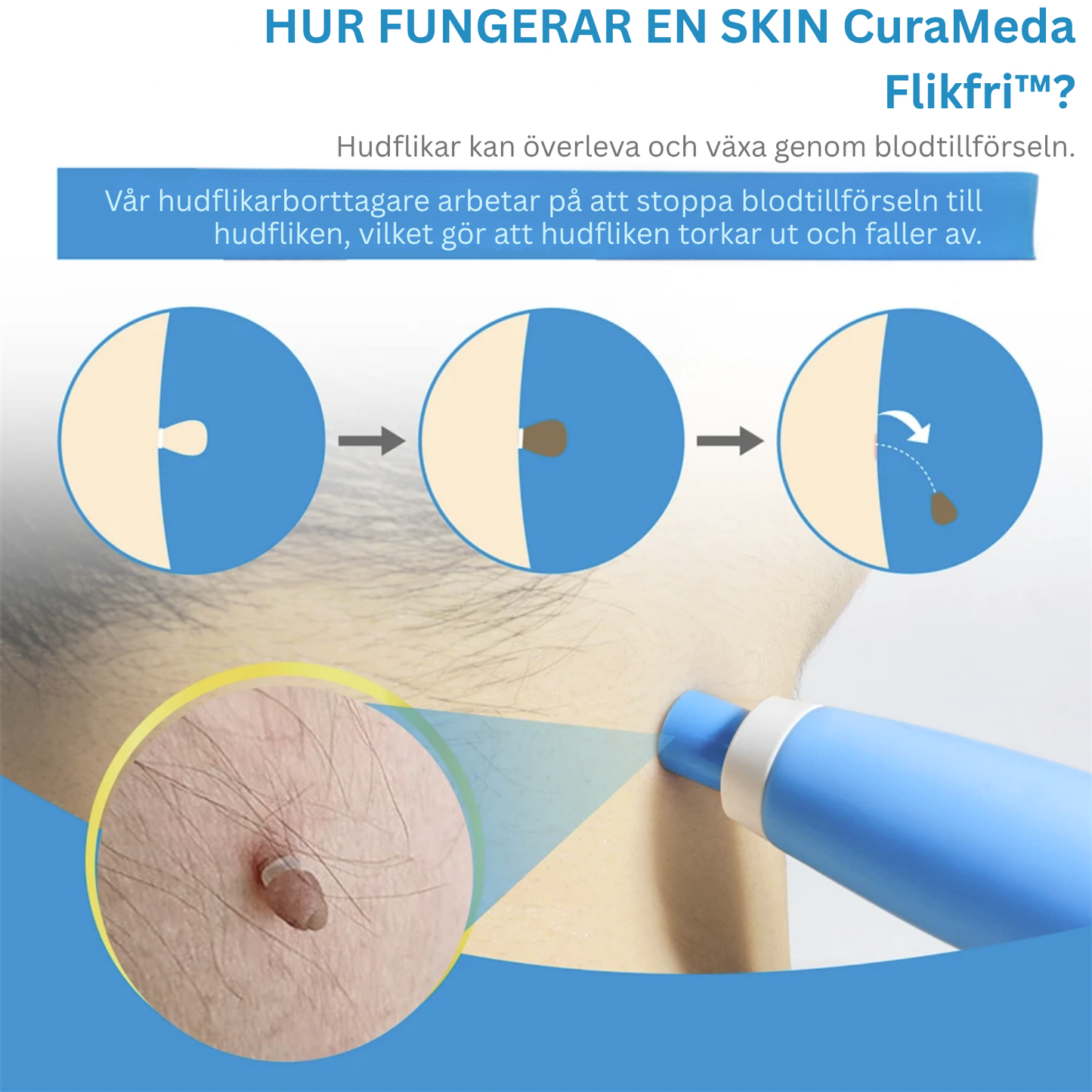 CuraMeda Flikfri™ Komplett Set